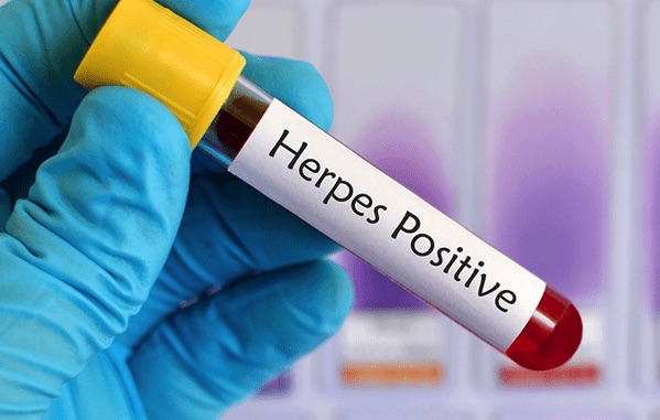 Herpes genitalis diagnose mann