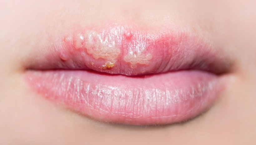 HSV1 and Cold Sore online treatment - Herp Alert